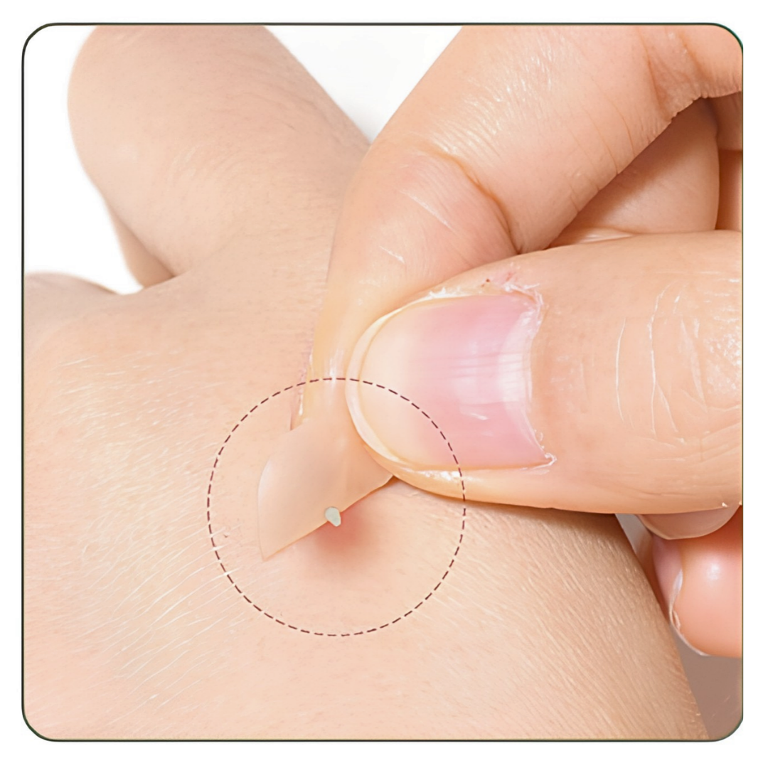 Acne Patch